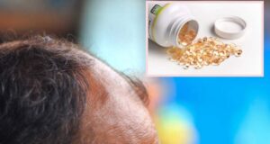 Mungesa e vitaminës D: Shenja paralajmëruese në kokën tuaj