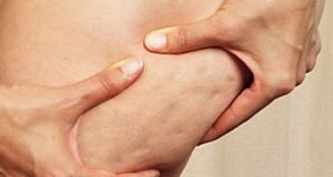 Këto janë ushqimet që shkaktojnë celulitin keto-jane-ushqimet-qe-shkaktojne-celulitin