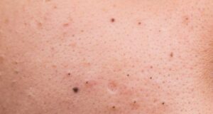 Maska më efektive që pastron lëkurën në thellësi nga pikat e zeza maska-me-efektive-qe-pastron-lekuren-ne-thellesi-nga-pikat-e-zeza