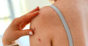 Akne në trup? – Kjo është zgjidhja akne-ne-trup?-–-kjo-eshte-zgjidhja