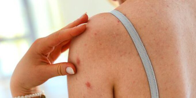 akne-ne-trup?-–-kjo-eshte-zgjidhja