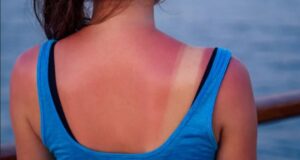 Metoda natyrale për të kuruar djegien nga dielli në kushte shtëpie metoda-natyrale-per-te-kuruar-djegien-nga-dielli-ne-kushte-shtepie